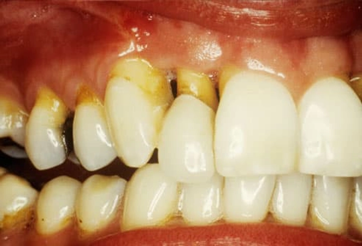 Receding Gums