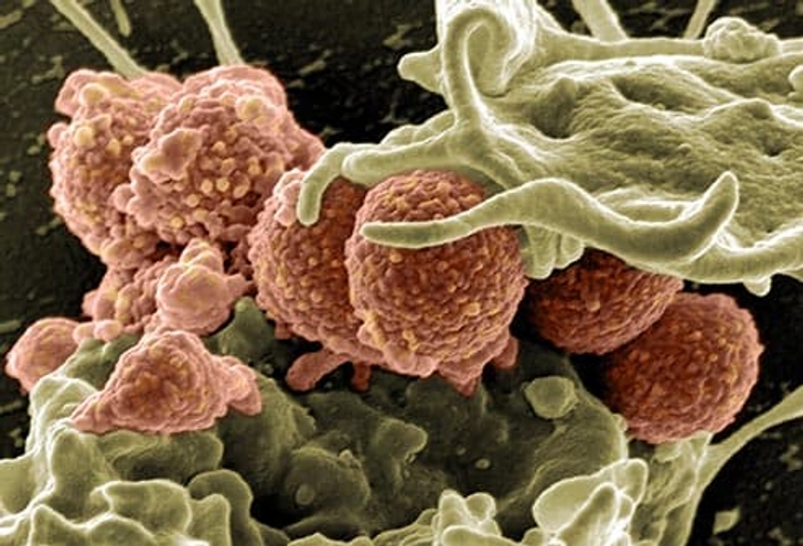 Sepsis From MRSA