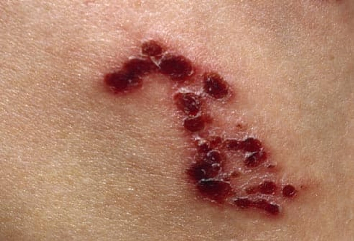 How Long Does Shingles Last?