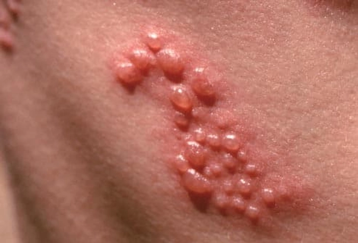 Diagnosing Shingles Diagnosing Shingles