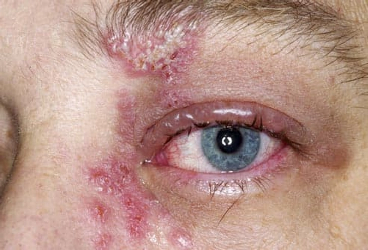 Other Complications of Shingles Other Complications of Shingles