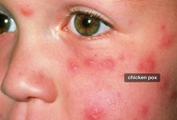 Is Shingles Contagious? Is Shingles Contagious?