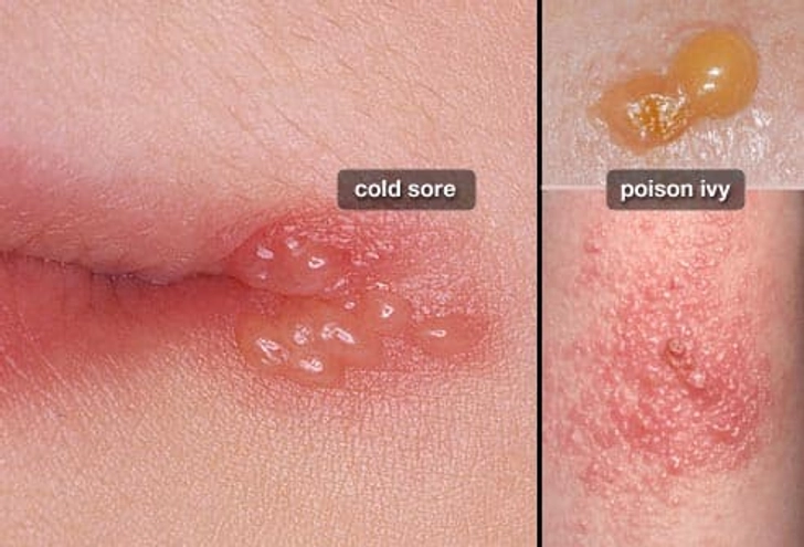 Shingles or Something Else?