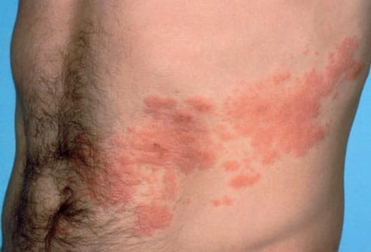 What Does the Shingles Rash Look Like? What Does the Shingles Rash Look Like?