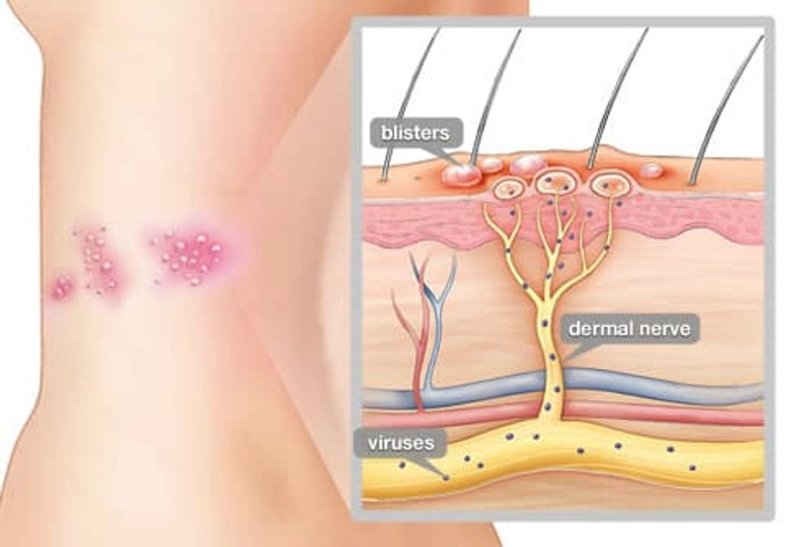 What Causes Shingles? What Causes Shingles?
