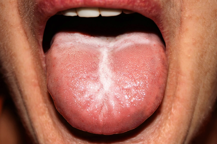 Candidiasis (Thrush) Candidiasis (Thrush)