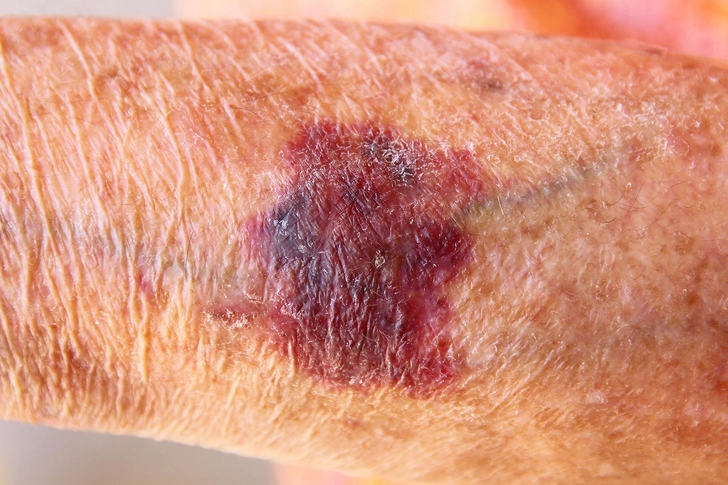 Bruising and Bleeding Bruising and Bleeding