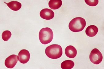 Anemia