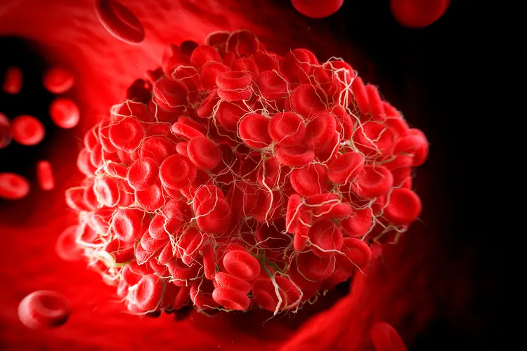 photo of large blood clot