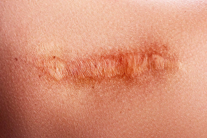 Changes in Surgical Scars