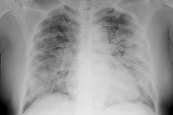 Shortness of Breath