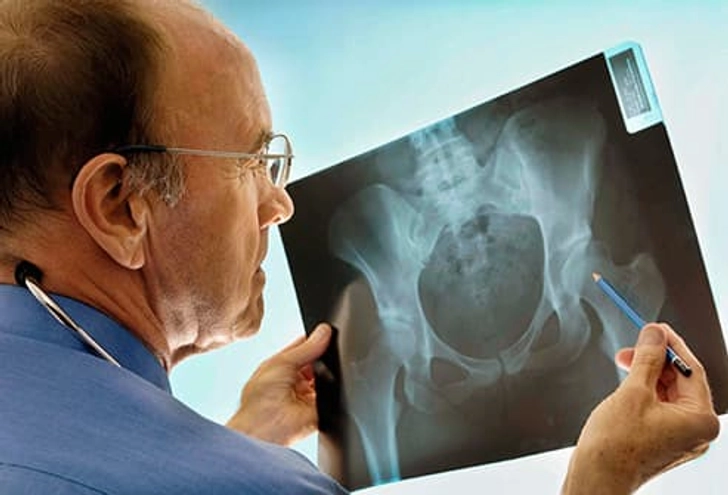 Bone Loss