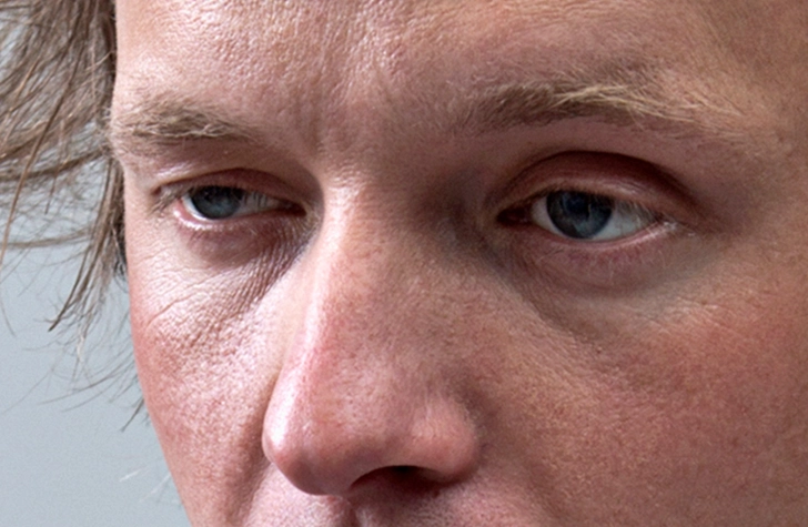 Bags Under Eyes