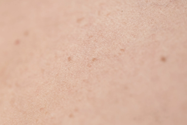 Dull Skin