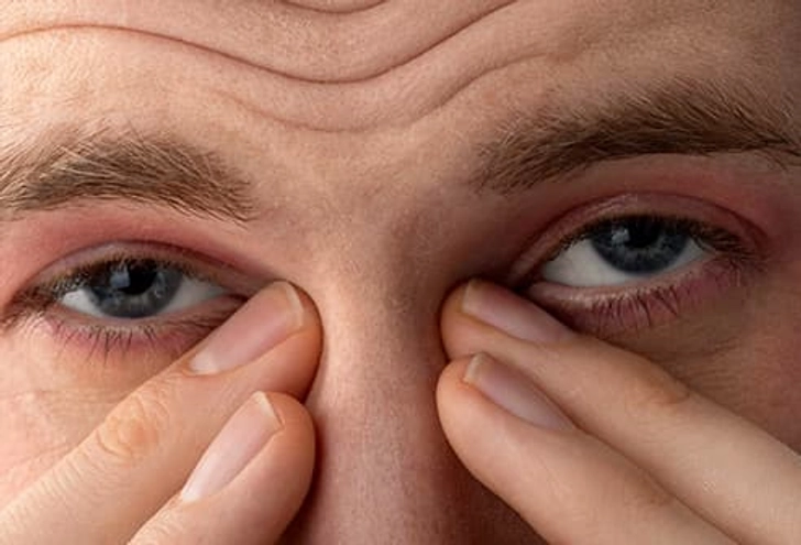 Itchy, Watery Eyes Itchy, Watery Eyes