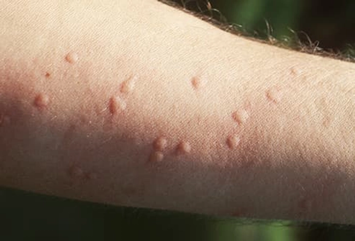 Hives