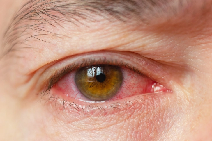 Red, Watery Eyes Red, Watery Eyes