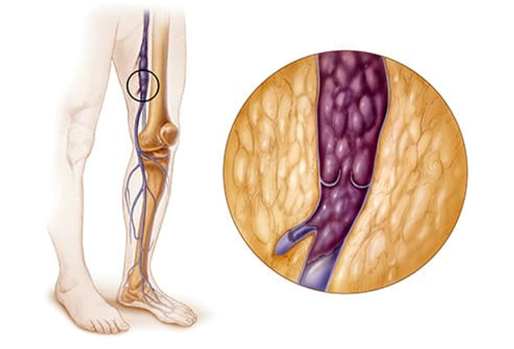 Blood Clots: DVT and PE Blood Clots: DVT and PE