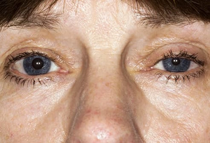 Eye Problems Eye Problems