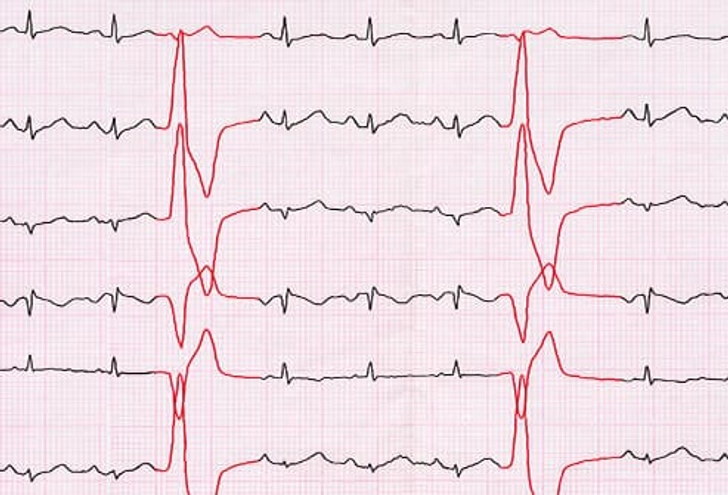 Heart Problems