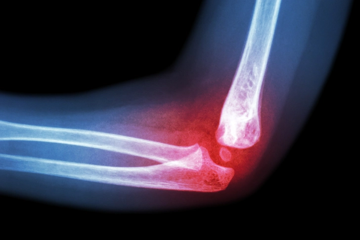Swollen, Red, or Warm Joints Swollen, Red, or Warm Joints