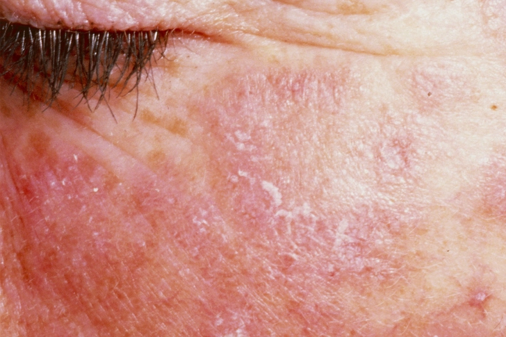 New or Worsening Rashes