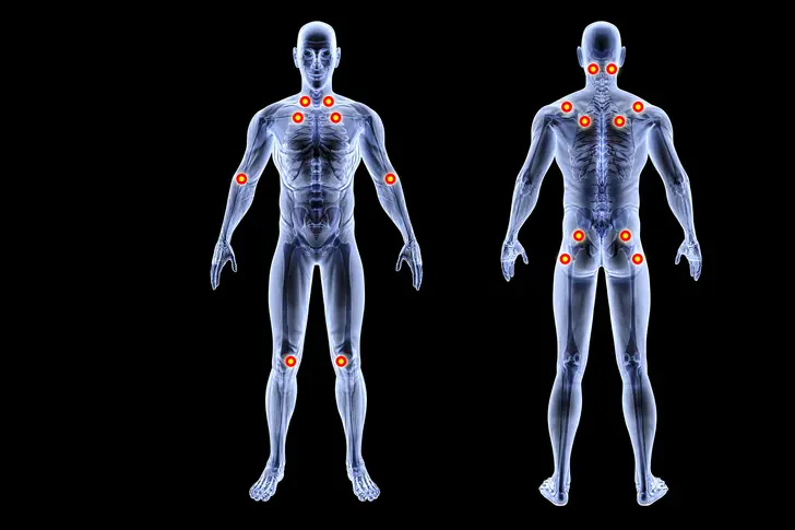 Fibromyalgia Fibromyalgia