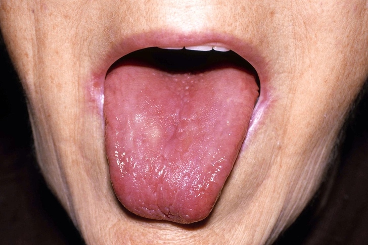 Smooth Tongue