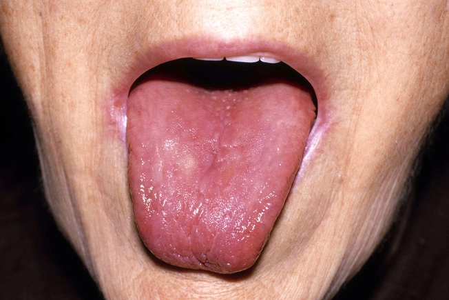 Smooth Tongue