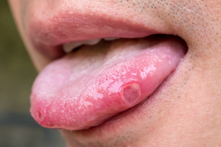 Mouth Sores
