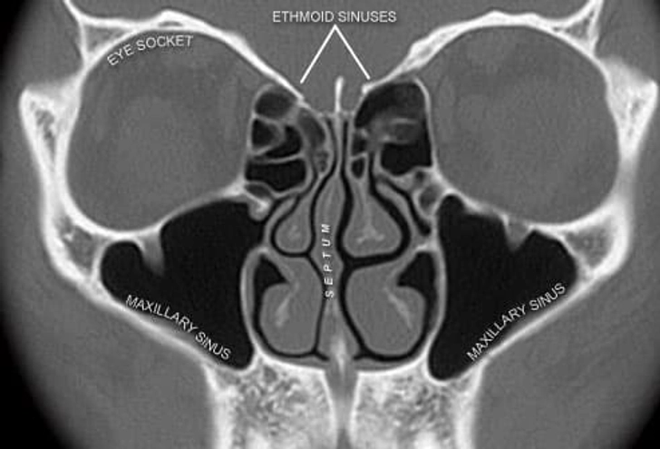 What Are Sinuses?