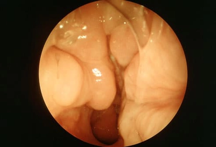 Nasal Polyps