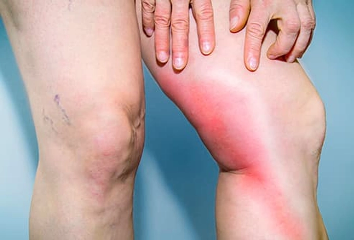 You Could Get DVT You Could Get DVT