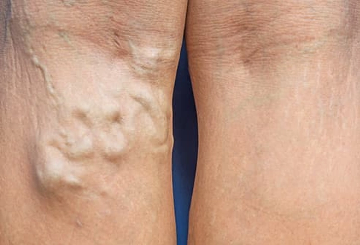It Leads to Varicose Veins It Leads to Varicose Veins