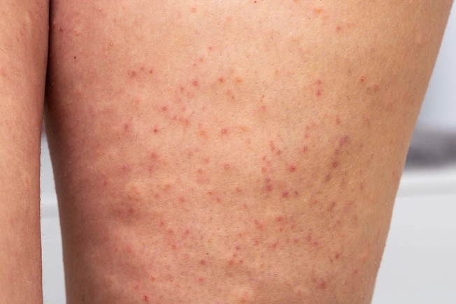 Keratosis Pilaris