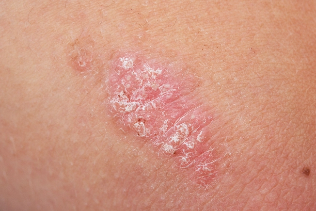 Psoriasis