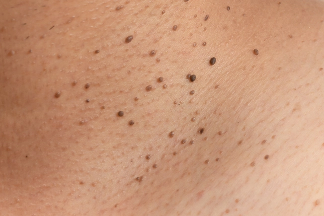 Skin Tags