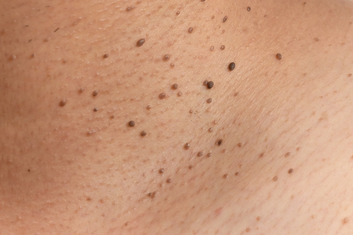 Skin Tags