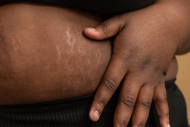 photo of stretch marks