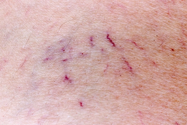 Varicose Veins