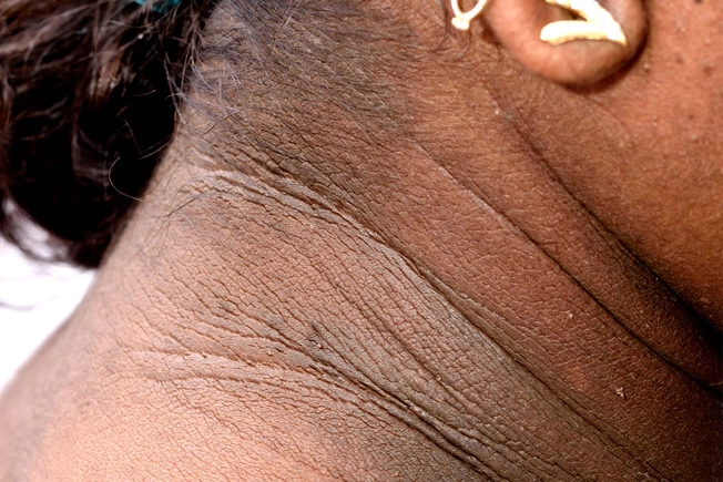 Acanthosis Nigricans