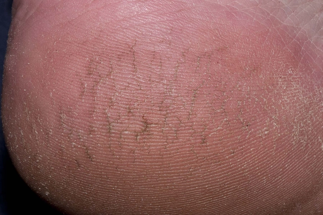 Plantar Hyperkeratosis