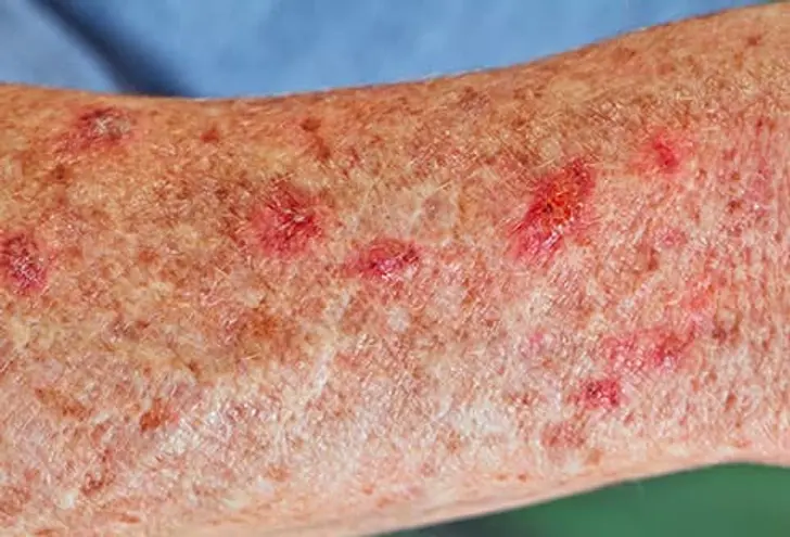 Actinic Keratosis
