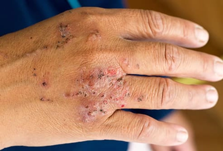 Contact Dermatitis