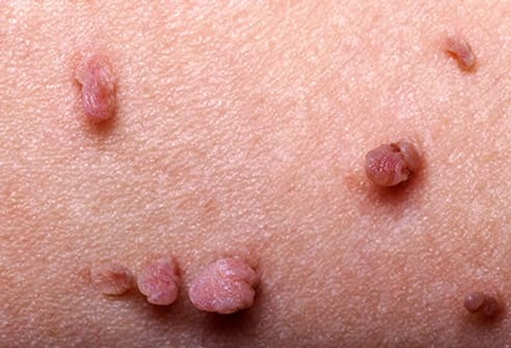 Skin Tags