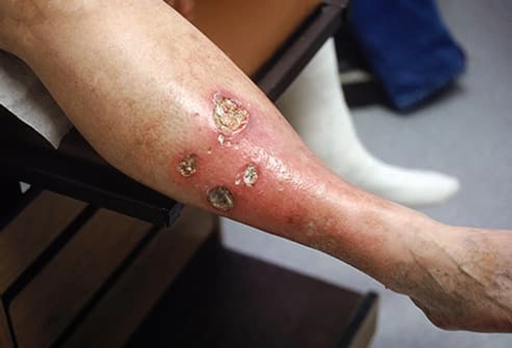 Leg Ulcers