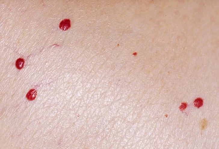 Cherry Angioma