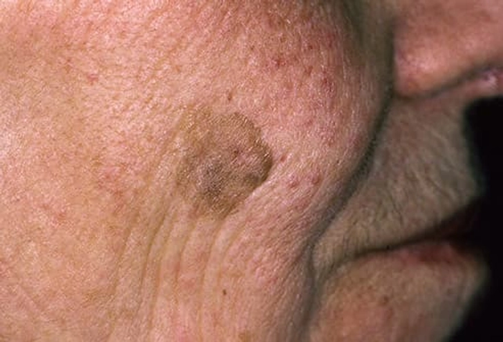 Seborrheic Keratosis Seborrheic Keratosis