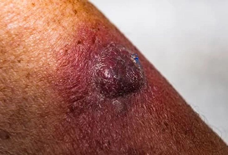 Skin Cancer