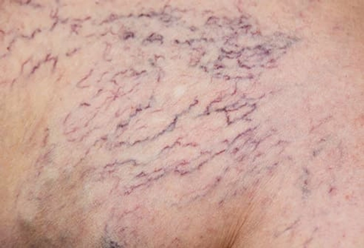 Spider Veins